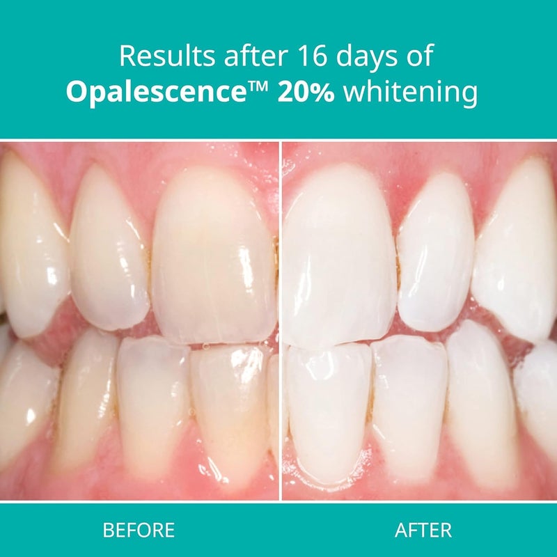 Opalescence 20% with PF Whitening Whitening Refill Kit (8 Syringes) Carbamide Peroxide. Made by Ultradent, in Melon Flavor. Tooth Whitening Refill Syringes - B-5401-4 - Image 4