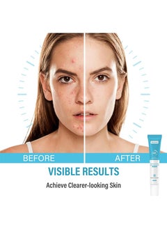 MOOYAM Salicylic Acid Salvia Miltiorrhiza Remove Acne Gel Lighten Acne Marks Remove Acne and Shrink Pores Plant Essence-Fast Acne Removal in 12 Hours to See Results  - Image 3