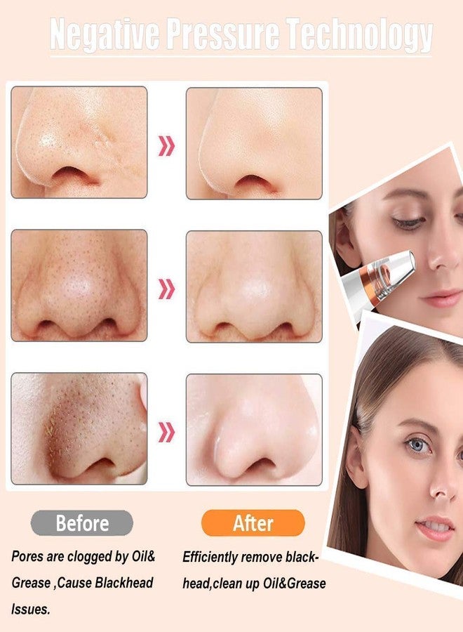 PIPALIYA Multifunctional Blackhead Whitehead Extractor Remover Acne, Pimple, Pore Cleaner Vacuum Suction Tool For Men And Women (MULTI COLOUR) - Image 5
