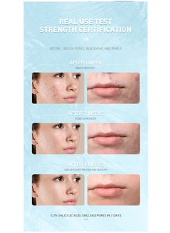AuQuest Salicylic Acid Acne Treatment Cream, Acne Treatment Prevent Breakouts, Face Cream Whitening Facial Treatment Hyaluronic Acid Black Dots Remove Skin Care Beauty Health, Hydrating and Repairing Sensitive Skin Moisturizing Base Serum 15ml  - Image 5