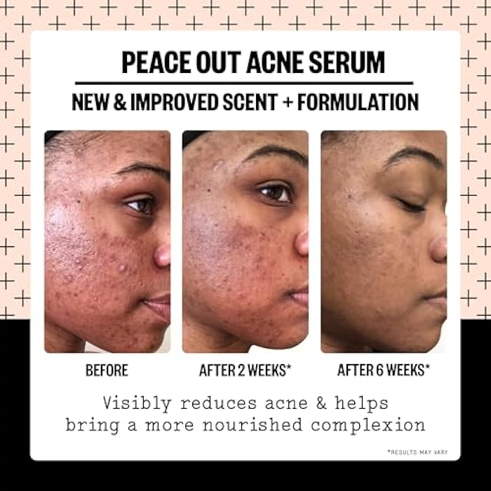 PEACE OUT Skincare Acne Serum. Daily Multi-Benefit Face Serum with 2% Salicylic Acid to Target Pimples, Zits, Blemishes and Breakouts, For Clearer-Looking Skin 1 fl oz - Image 3