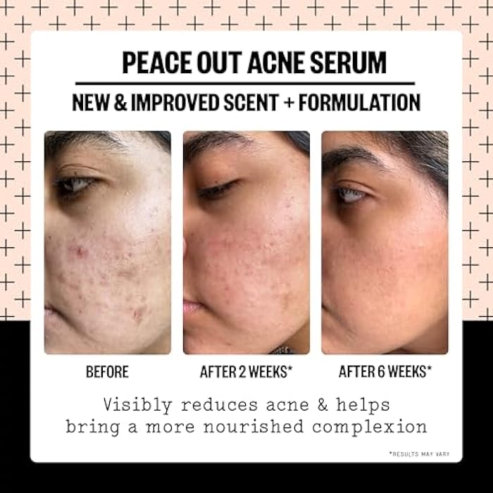 PEACE OUT Skincare Acne Serum. Daily Multi-Benefit Face Serum with 2% Salicylic Acid to Target Pimples, Zits, Blemishes and Breakouts, For Clearer-Looking Skin 1 fl oz - Image 4