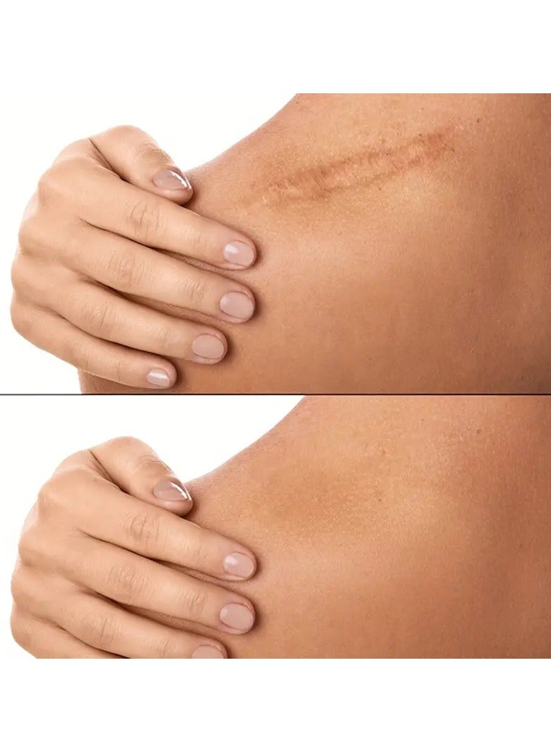 ORiTi لفافة جل السيليكون 4سم*150سم لاصقة جروح السيليكون بلون البشرة غير مرئية - Image 5