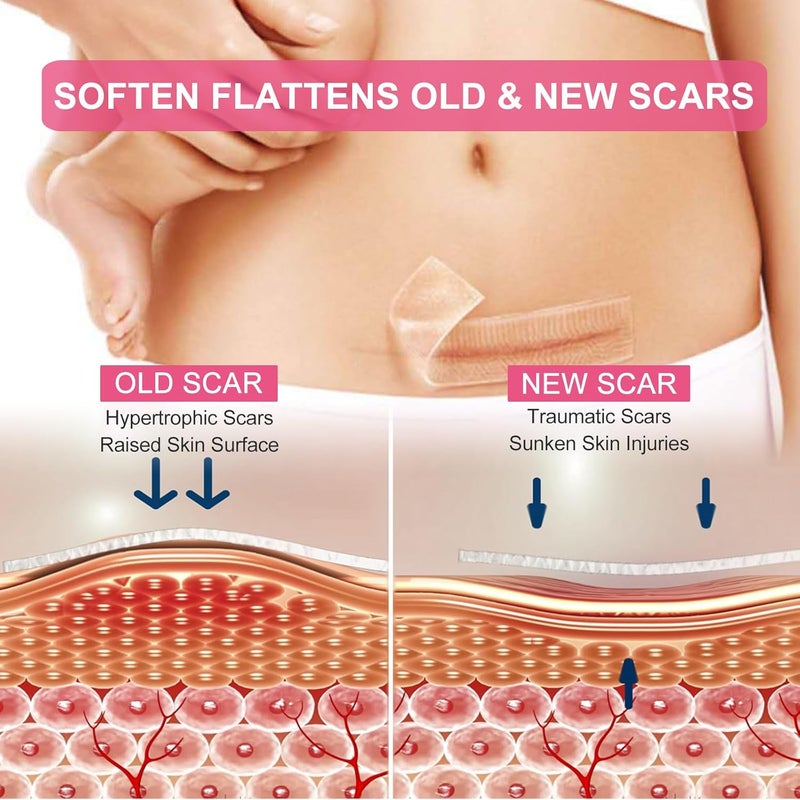Silicone Scar Sheets Clear Silicon Gel Scar Sheets Invisible Scar Tape16 x 120Roll3M Scar Strips for Surgical Scars Medical Grade Scar Removal Sheets for CSection Breast Keloid et - Image 2