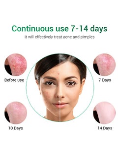 Breylee Acne Treatment Cream, Acne Removal Acne Pimple Repair Cream, Natural Cystic Acne Treatment, Premium Acne Scar Cream And Pimple Remover, 20G  - Image 4