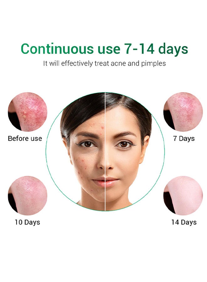 بريلي كريم حب الشباب علاج حب الشباب كريم حب الشباب - Image 4