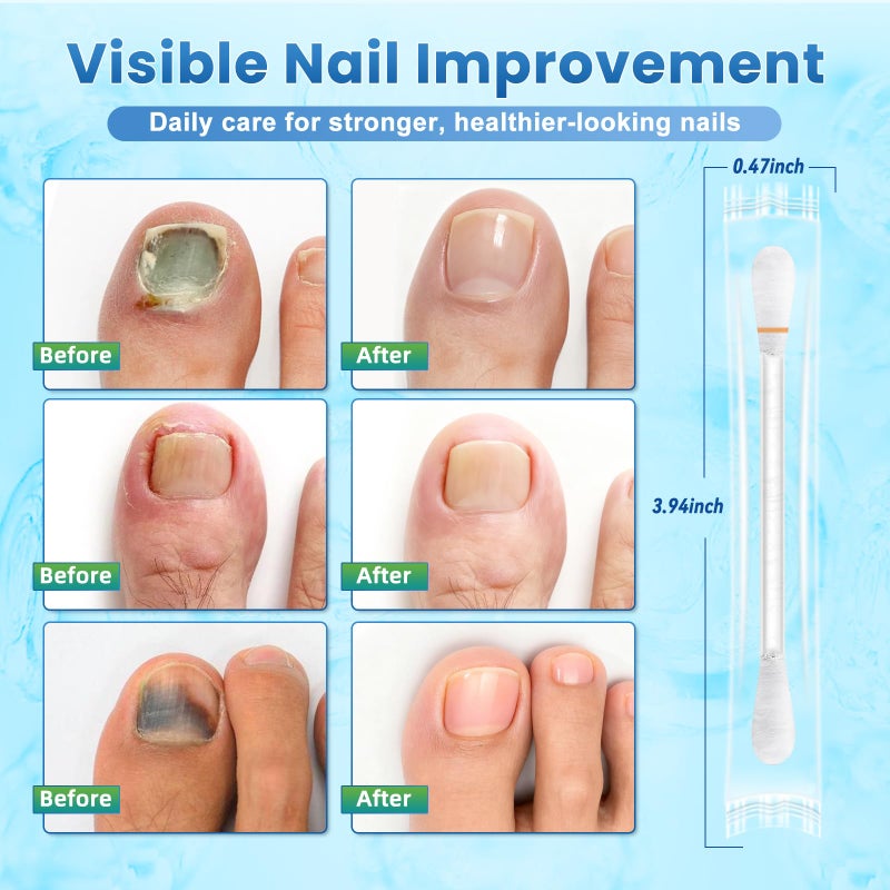 ONIADBA Fungal Nail Treatment Swabsâ€“100 Ct, Extra Strength Toenail & Athleteâ€™s Foot Fungus Treatment with 25% Undecylenic Acid, Damaged, Discolored & Thick Nails, Restores Healthy Nail Growth - Image 3
