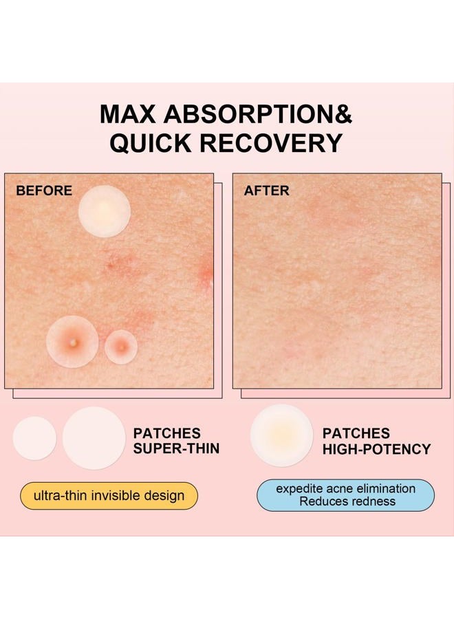 AVJONE Pimple Patches for Face(144 Patches), Hydrocolloid Acne Patches with Tea Tree Oil, pimple stickers for Breakouts, Absorbs Zit, Invisible Spot Cover and Blemish - Image 3