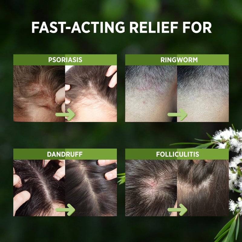 Roycederm Tea Tree Scalp Relief Spray: Leave-In Scalp Care for Dry, Flaky, and Itchy Scalp - Tea Tree Oil Formula for Comfort, Hydration, and Balance - Conditioning Support for Women & Men - Image 3