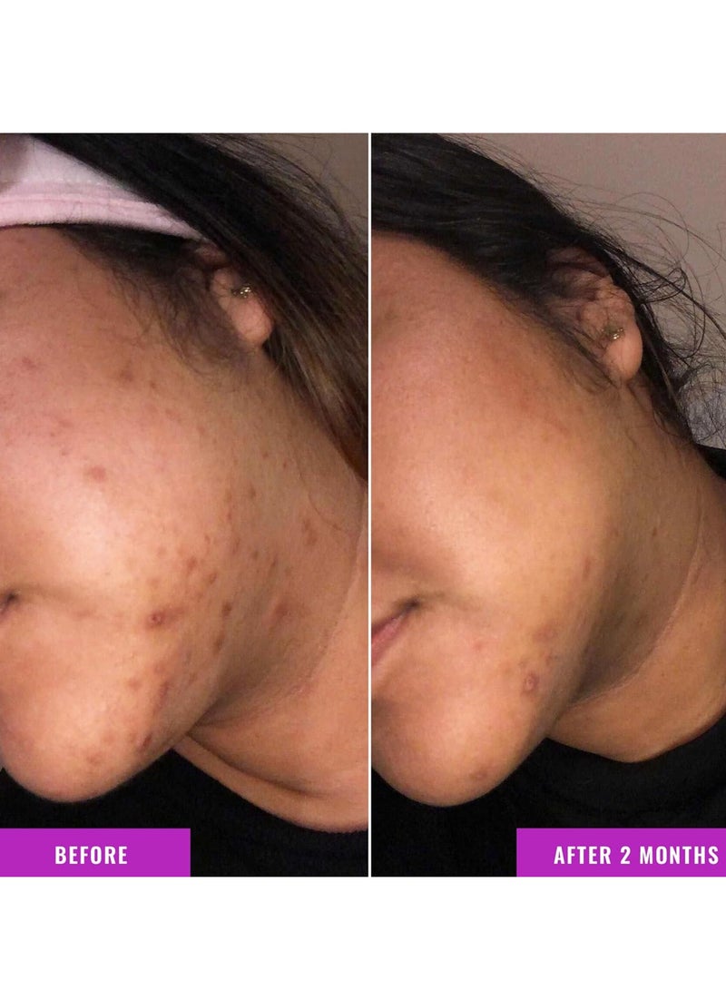 مصل تصحيح تغير اللون من جود موليكولز - ملح إستر حمض الترانيكساميك والنياسيناميد للبقع الداكنة، تلف الشمس، وبقع الشيخوخة - عناية بالبشرة للوجه - Image 4