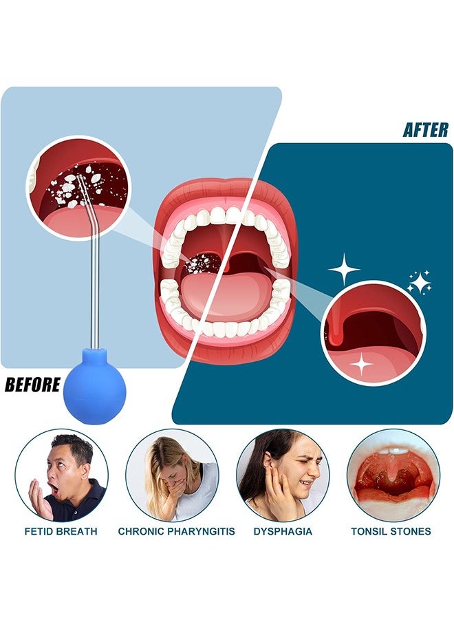 فيرستار - مزيل حجر اللوزتين ، منظف الفم اليدوي ، أداة حجامة حجر اللوزتين بالفراغ (أزرق) - Image 1