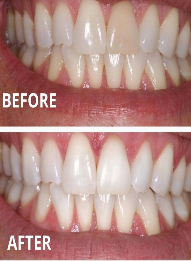 Expertwhite 16% Carbamide Teeth Whitening Gel Made in The USA for Sensitive Teeth (4 gels, 3cc Each). The Best Gel for Bright White Teeth is Used with Any Trays. - Image 2