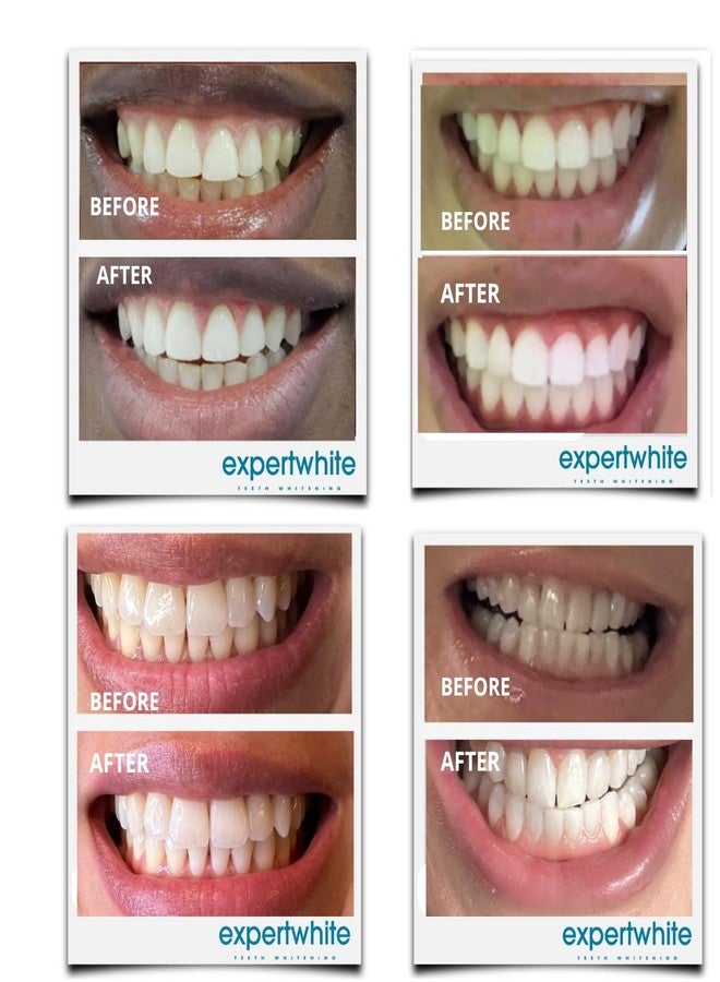Expertwhite 16% Carbamide Teeth Whitening Gel Made in The USA for Sensitive Teeth (4 gels, 3cc Each). The Best Gel for Bright White Teeth is Used with Any Trays. - Image 3