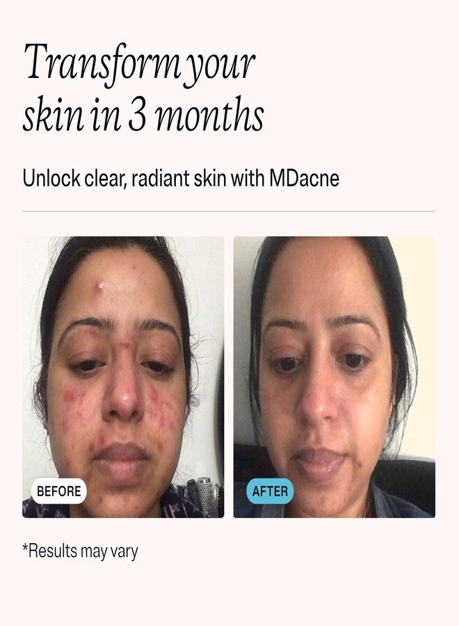 MDacne كريم علاج حب الشباب MDacne حمض الساليسيليك 2.0% - مقشر للوجه يفتح المسام، يمنع العيوب، الرؤوس السوداء، التجاعيد والخطوط الدقيقة، يقلل من التهيج للبشرة الحساسة المعرضة لحب الشباب (1 عبوة) - Image 3