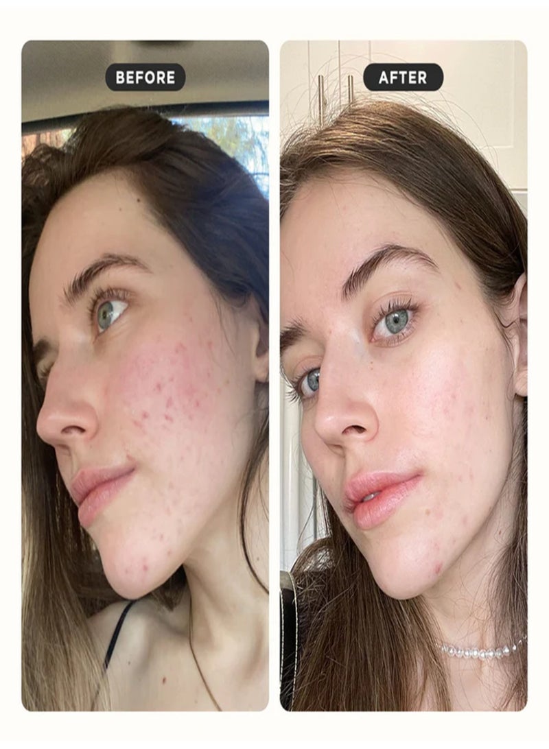 ZitSticka Press Refresh Exfoliating & Hydrating Sheet Mask – Soothe Acne-Prone Skin (1 Pack) - Image 4