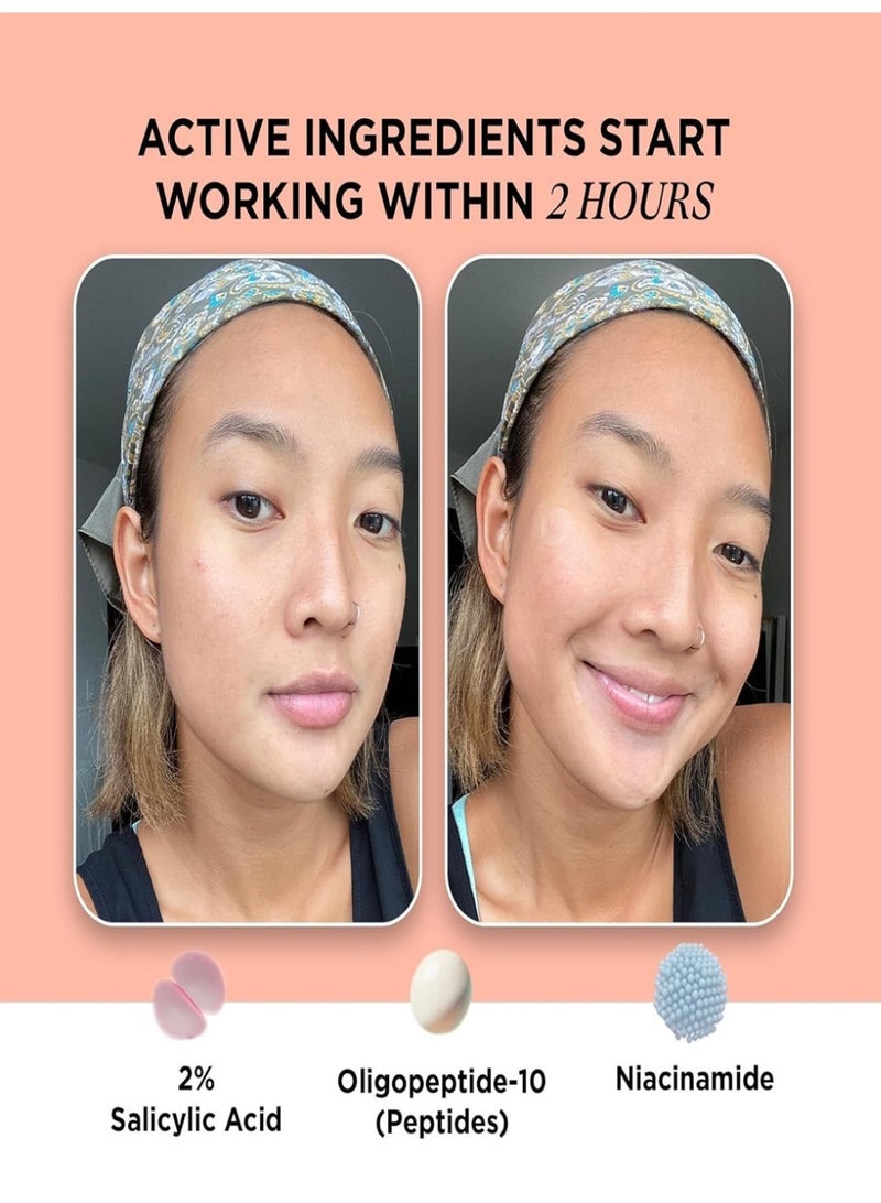 ZitSticka KILLA Extra Strength Microdart Acne Patches with 2% Salicylic Acid – Targeted Blemish Treatment - Image 5