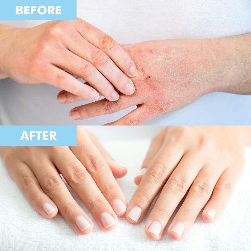 Bodipure Premium Hand and Foot Mask | Moisturizing Kertain Gloves & Socks | Hydrating Dull Dry Hands, Cracked Heels, Callus Softening & Nail Strengthening | Chemical-Free Feet Treatment | (6+6 Pack) - Image 5