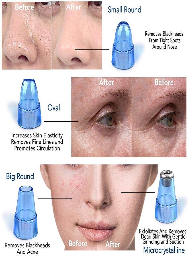 lele? Multi-functional Vacuum Acne Pore Cleaner Blackhead Remover Vacuum Kit, Facial Skin Cleaner For Men And Women, Pimple Removal Tool, Acne Removal Tool, Blackhead Remover Tool, Vacuum Suction Tool - Image 3