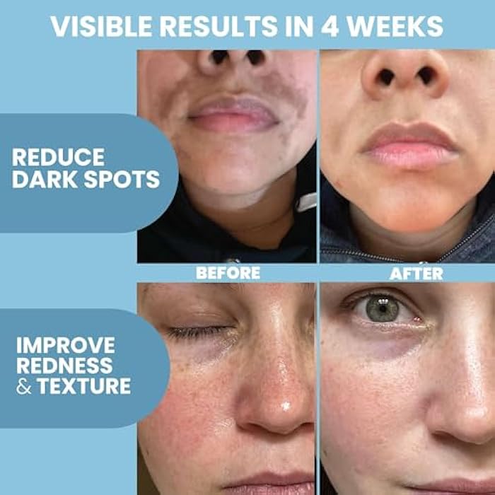 Eva Naturals Azelaic Acid Serum for Face – Niacinamide, Hyaluronic Acid, Vitamins A+C+E – Redness Relief, Dark Spots, Uneven Skin Tone, Texture, Pores, Topical Booster for Clearer, Smoother Skin, 2oz - Image 4