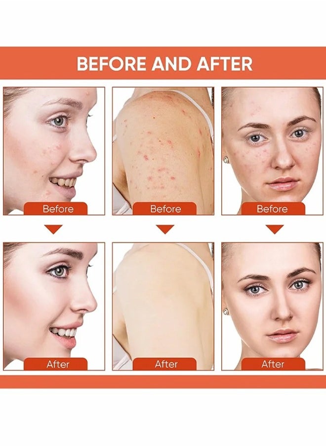 Acne Face Cream-Lactic Acid Treatment Cream Acne AHA Face Cream Anti-Acne Moisturizer 30g