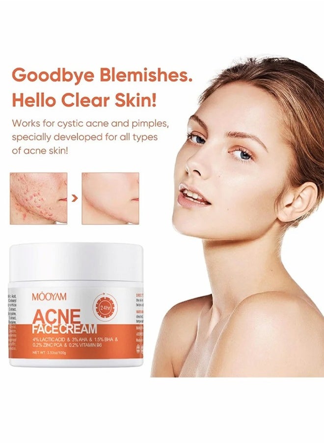 Acne Face Cream-Lactic Acid Treatment Cream Acne AHA Face Cream Anti-Acne Moisturizer 30g