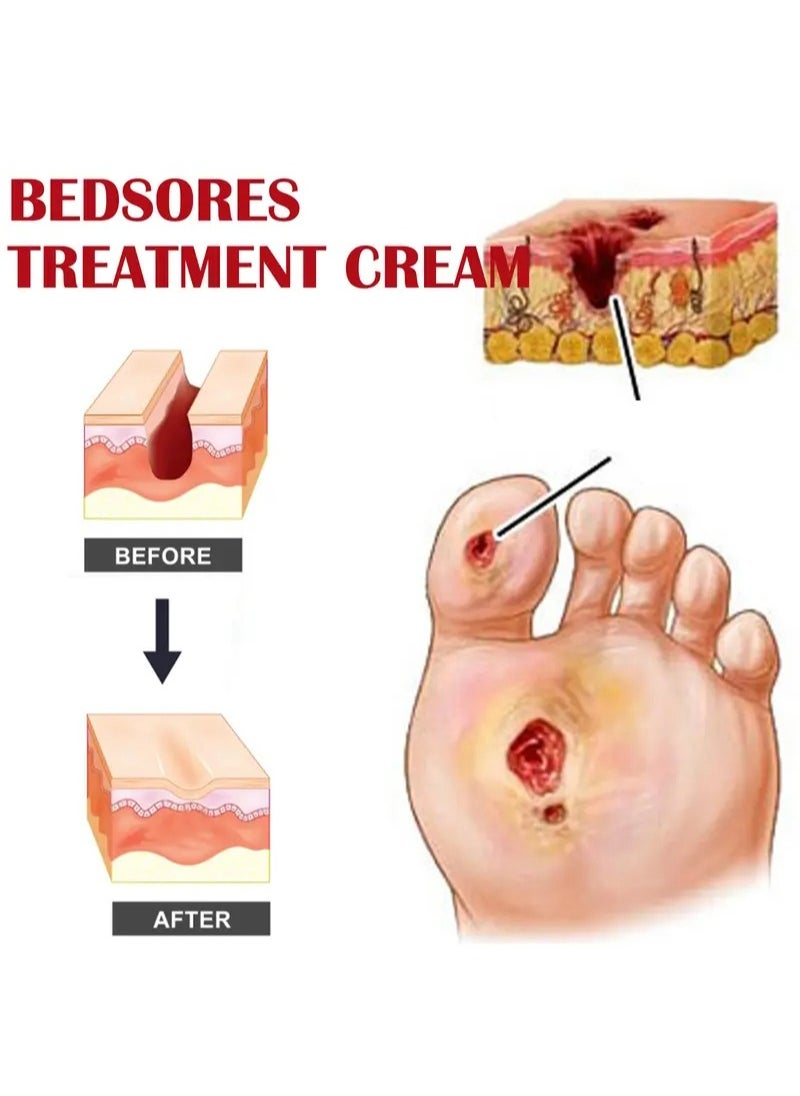 EELHOE - Decubitus Repair Cream，Bedsores Treatment Cream-Rapid Healing of Bedsores and Pressure Ulcers，Deep Penetration Soothing Natural Moisturizing Cream，Easy to Apply Sore Relief - Image 1
