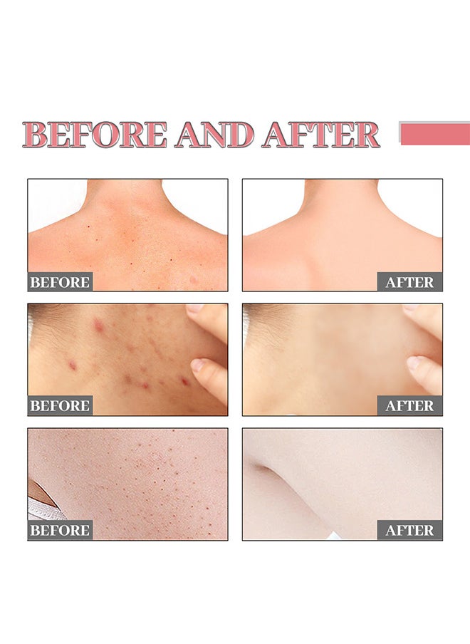 Jaysuing - Vitalizing Salicylic Acid Scrub Soap, Pore Exfoliating, Softening Skin, Anti-blemishes, Removing Acne, Exfoliating, Desalting Acne Mark Moisturizing Skin Cleansing Soap Shower Soap - Image 1