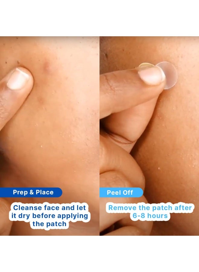 So True Sotrue Acne Pimple Patches For Face | For Active Surface Acne | Hydrocolloid Waterproof Patches | Absorbs Pimple Overnight, Reduces Excess Oil | Suits All Skin Types (54 Patches) - Image 5
