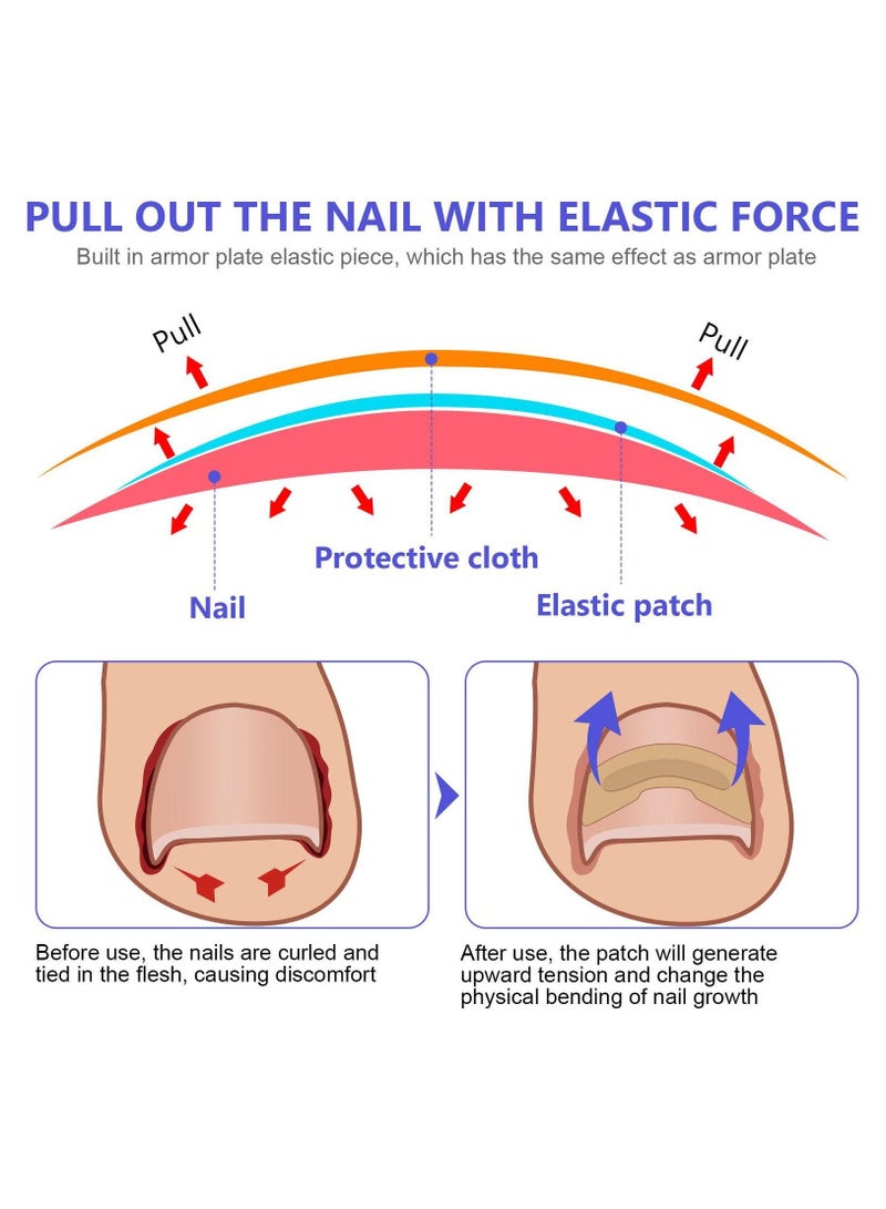 Sefudun 100 Pieces Ingrown Toenail Correction Stickers Toenail Corrector Patch Glue-free Ingrown Toenail Corrector Strips Toenail Correction File Patches Relieve Nail Groove Unisex - Image 5