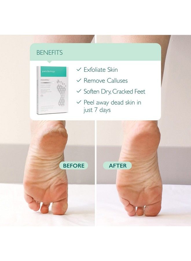 Patchology Poshpeel Pedi Cure Foot Peel Mask Soak Treatment Pedicure Foot Spa Feet Peeling Mask Pedicure Booties W Deep Exfoliation For Babysoft Skin Pedicure Supplies For Foot Care 1 Pair - Image 3