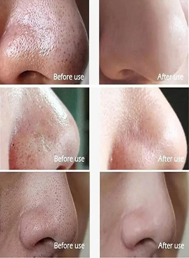 Lui Pui LUIPUI Paper Blackhead Remover Strips (Pack of 10) - Image 5