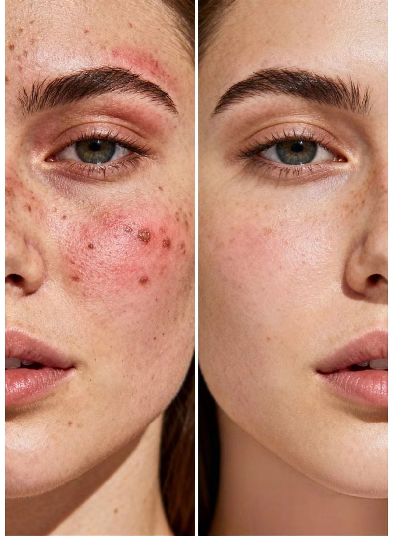 Skinoren Azelaic Acid 20% Cream - FDA Approved Acne Treatment for Pimples, Melasma & Dark Spots, with Vitamin C & Glycerin, Safe for Pregnancy, 30g - Image 4