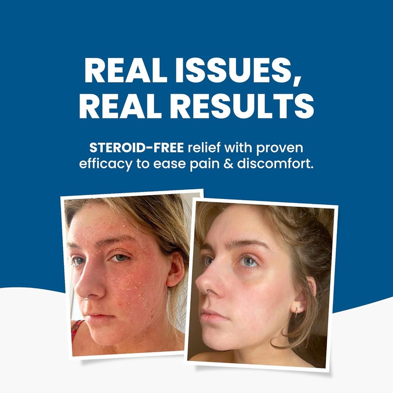 Grahams Natural C+ Cream Eczema Psoriasis & Dermatitis Relief - Image 2