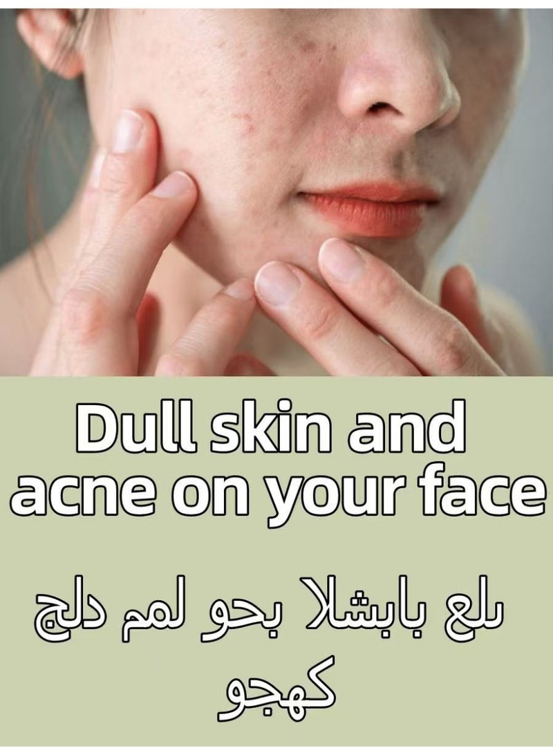 دي لا كروز ديلا كروز مرهم علاج حب الشباب بنسبة 10% كبريت - قوة قصوى 2.6 أوقية، مضاد للبكتيريا والالتهابات، للبثور والرؤوس السوداء، مختبر على الحساسية، للاستخدام اليومي، يخفف البقع - Image 2