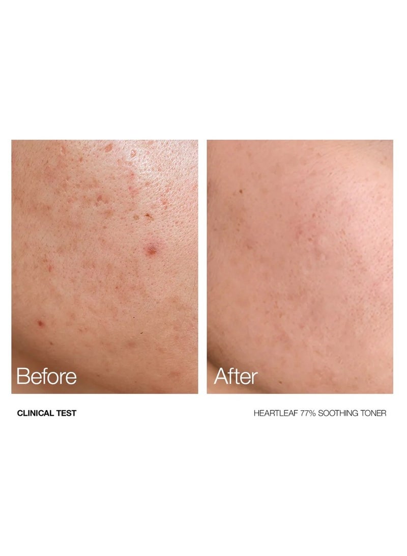 Anua Wonder Anua - Heartleaf 77% Soothing Toner 250ml + Beauty of Joseon Relief Sun : Rice + Probiotics SPF50+ PA++++ 50 ml - Image 2