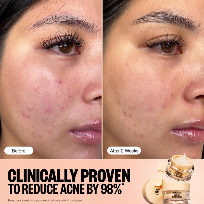 PEACE OUT Skincare Acne Gel Moisturizer, For Daily Facial Use with Salicylic Acid & Niacinamide, Boost Hydration and Help Prevent Acne & Blackheads, for Men & Women, 1.69 fl oz - Image 5