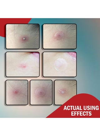 108 Pcs Miracle Pimple Patches Hydrocolloid Patches,Acne Pimple Patches for Face,Circle Facial Hydrocolloid Acne Patch,Master Blemish Patches,Acnes Spot Cover Stickers with Tea Tree Oil Invisible Acne Pimple Patches Blackhead Remover Patch - view 5