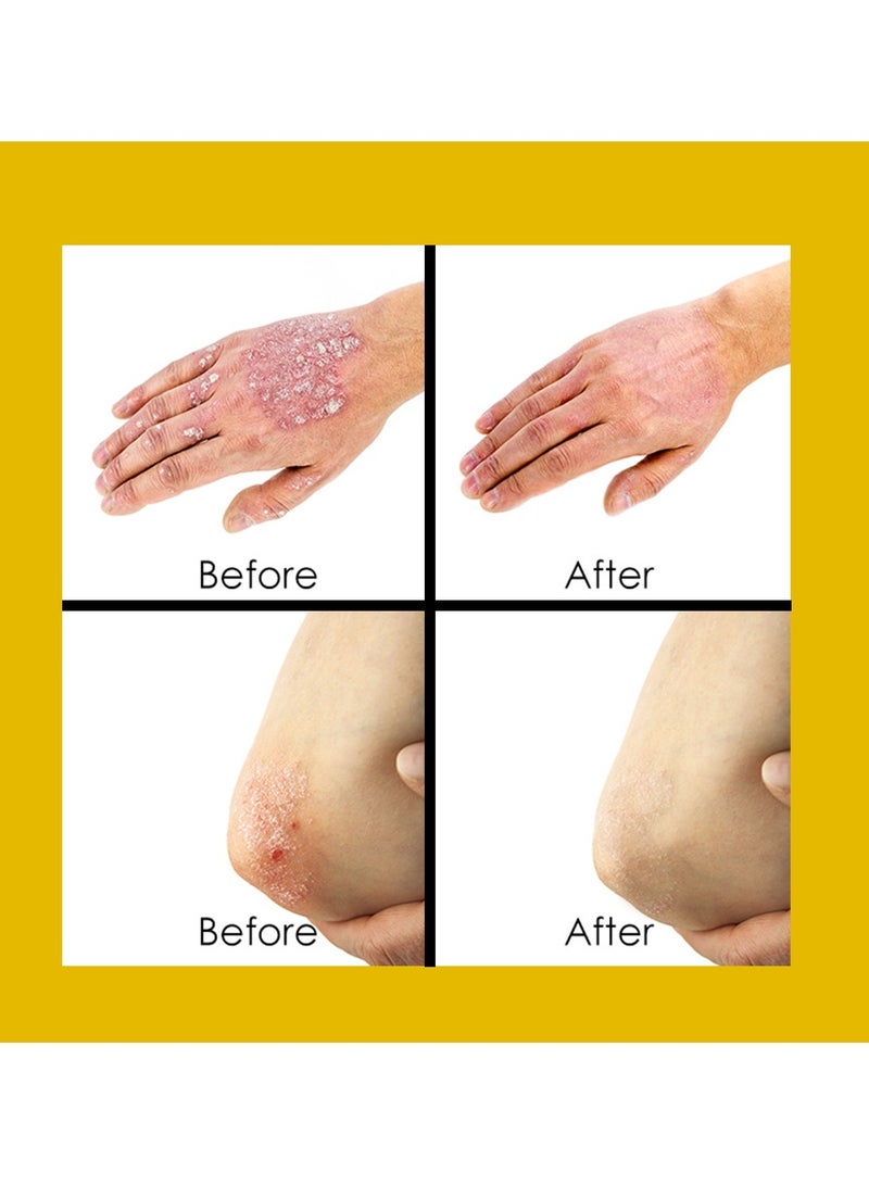 سوميفون الصدفية كريم لعلاج الصدفية الاكزيما كريم مضاد للجراثيم المضادة للحكة التهاب الجلد - Image 5