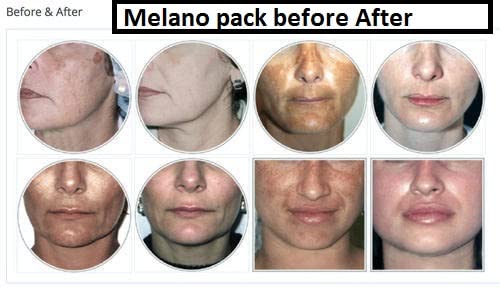 leeposh Melano Pack Yellow peel cream kit of 3 exfoliating Yellow peel Melano Pack Melano pack Yellow peel melano pack treat all skin imperfections like acne pigmentation pores Gets glow whitening - Image 5