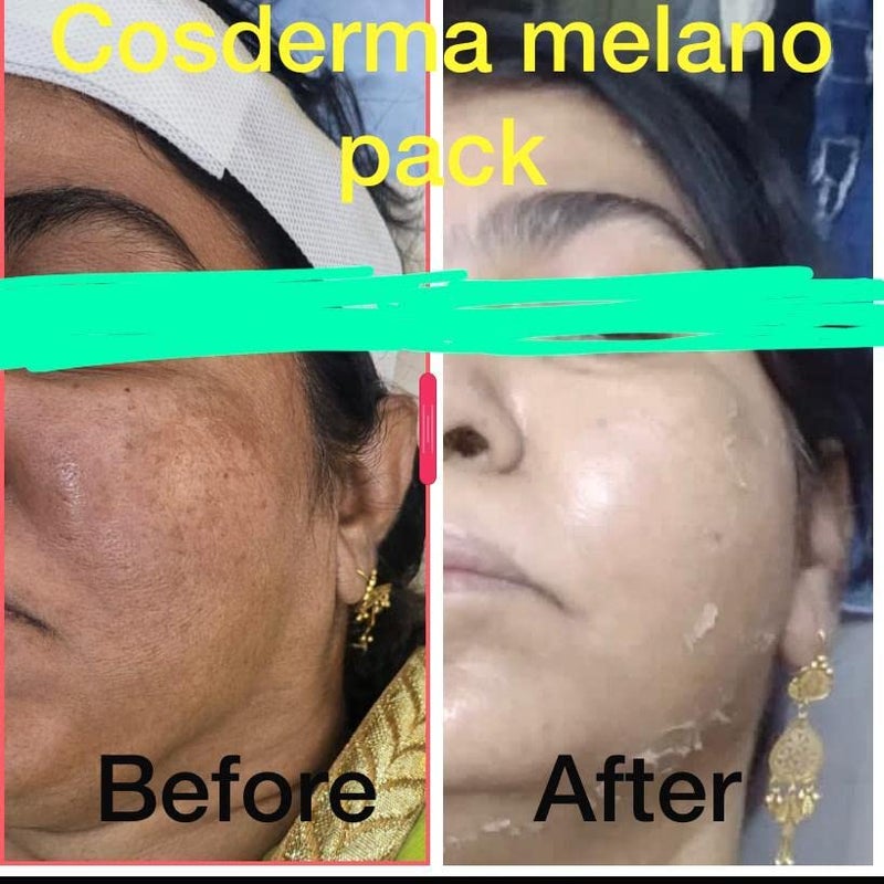 leeposh Melano Pack Yellow peel cream kit of 3 exfoliating Yellow peel Melano Pack Melano pack Yellow peel melano pack treat all skin imperfections like acne pigmentation pores Gets glow whitening - Image 4