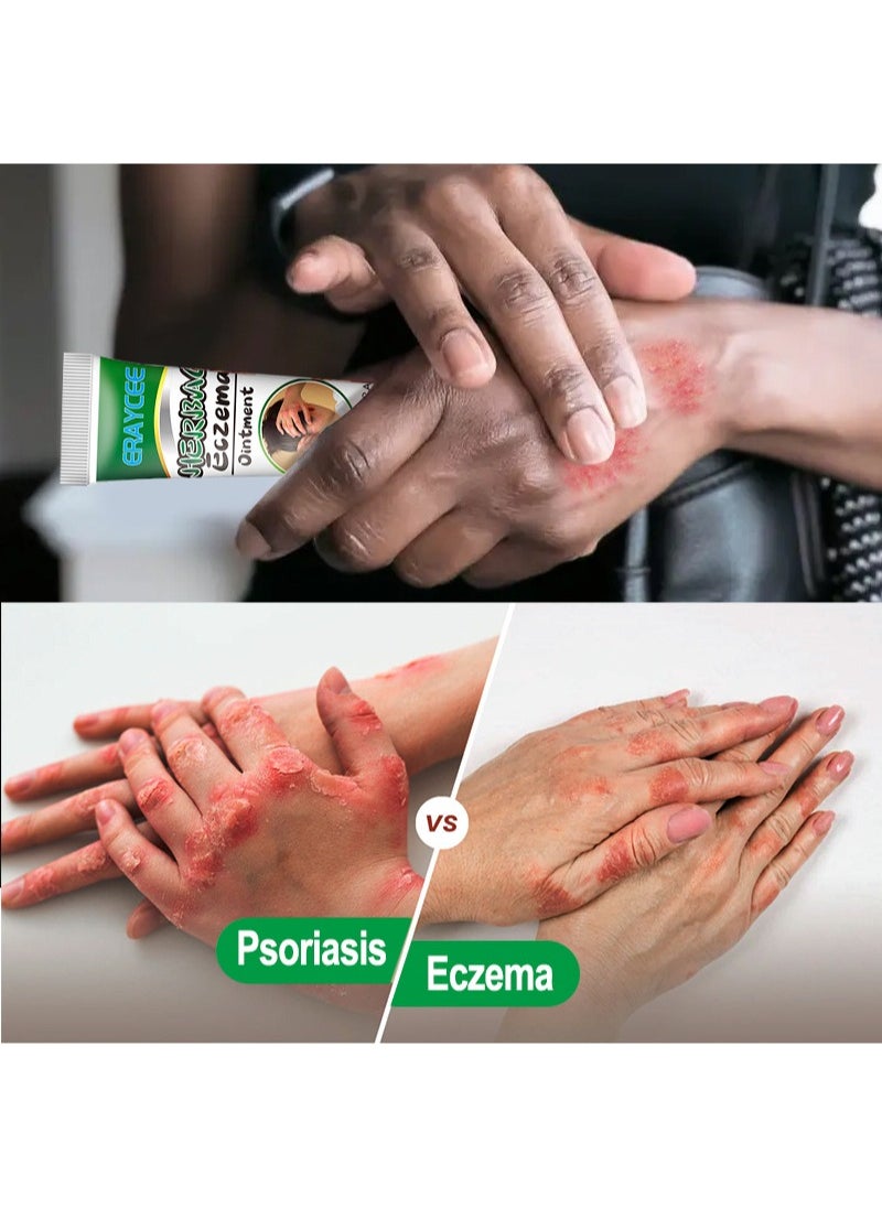 2 Pieces Herbal Eczema Ointment,Medical Ointment For Dermatitis, Antibacterial And Anti-Itching, Psoriasis Treatment