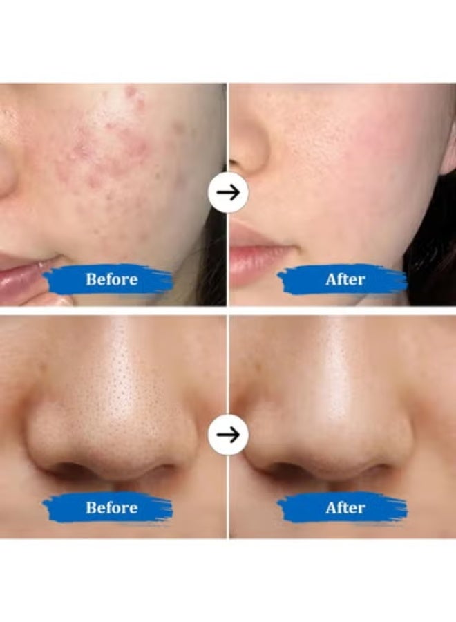 ملعقة تنظيف البشرة بالموجات فوق الصوتية - مقاومة للماء ومزيلة للرؤوس السوداء - ستانلس ستيل - خفيفة الوزن وعملية للتنظيف العميق - Image 2