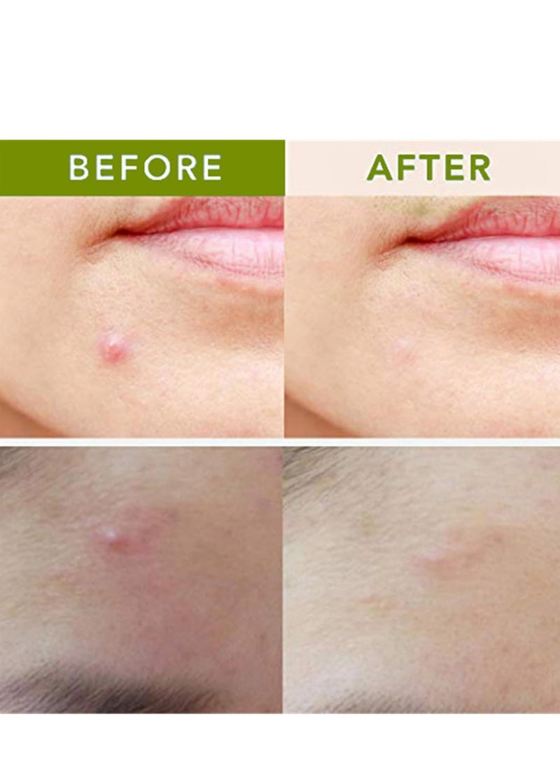 spot Pimple Patches, Invisible Spot Patches with CICA, Micropoint Acne Patch, Cystic Acne Patches, Efficient Pimple Patches Microneedle, Dark Spot Patches for Early-Stage Painful Zits, Pack of 12 - Image 2