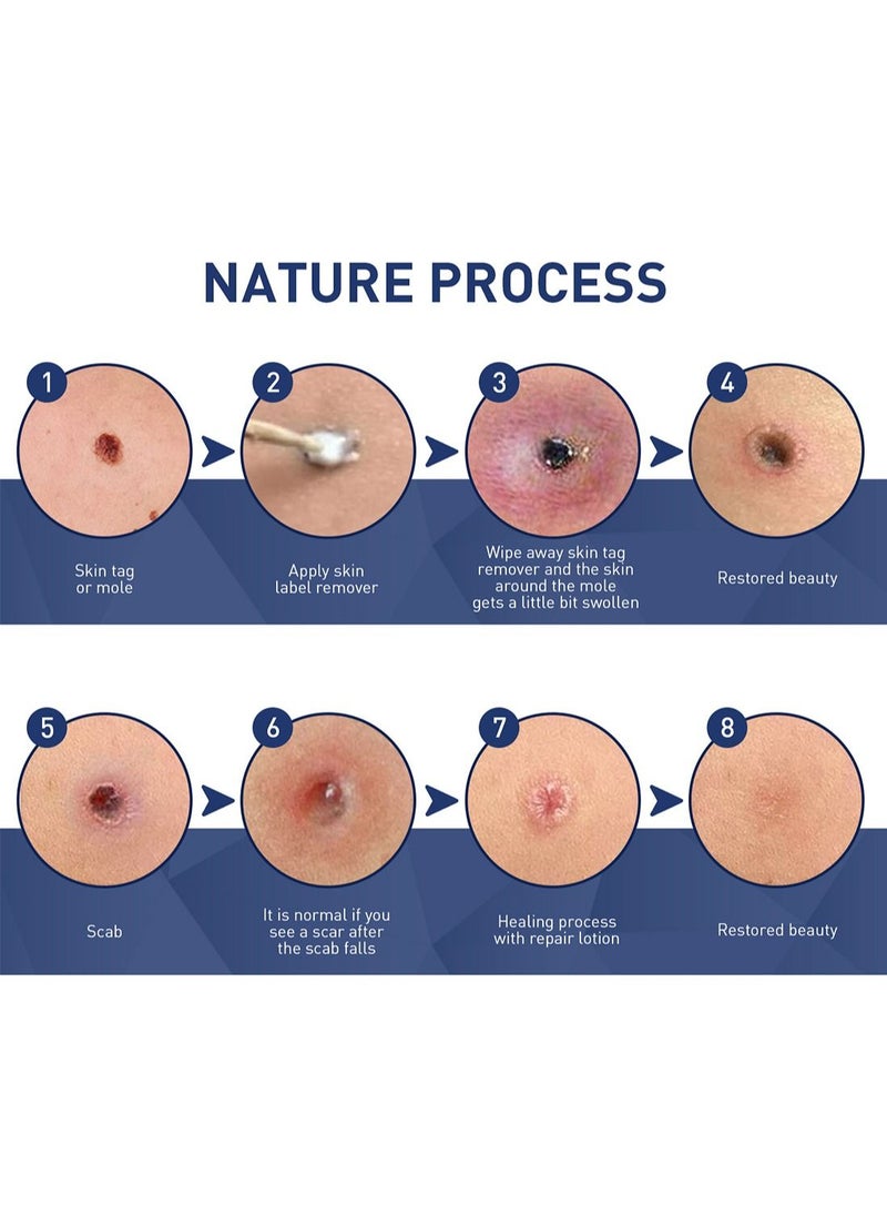 Skin Tag Remover Easy to Use Fast Effective Painless Natural Safe Suitable for All Skin Types
