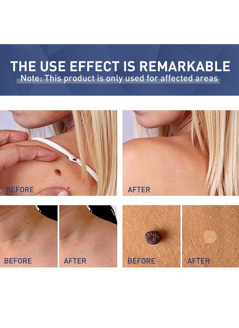 Skin Tag Remover Easy to Use Fast Effective Painless Natural Safe Suitable for All Skin Types