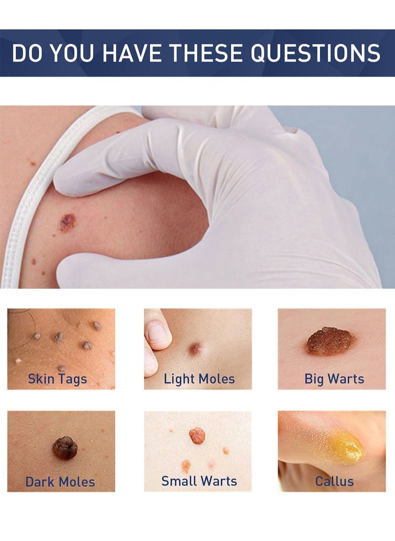 Skin Tag Remover Easy to Use Fast Effective Painless Natural Safe Suitable for All Skin Types