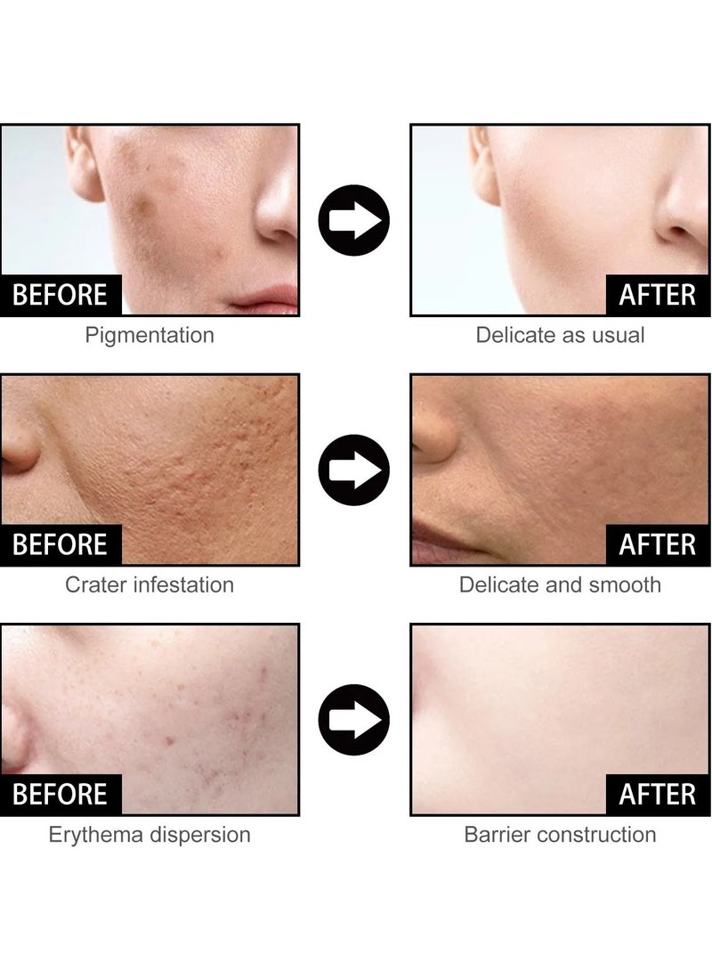 EELHOE Niacinamide Facial Essence, Whitening Pimple Treatment Hyaluronic Acid Serum, Anti Wrinkle And Anti Aging Face Serum For Pimple, Acne And Pore Shrinking, (1pc, 5oml) - Image 4