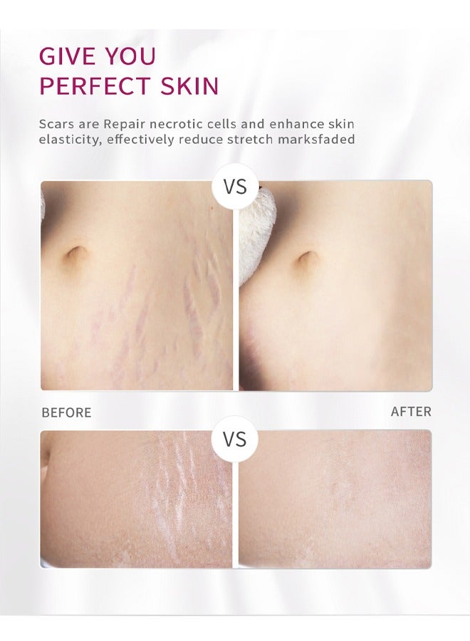 RtopR Mango Pregnancy Scars Cream For Maternity Repair Stretch Marks Enhance Skin Elasticity, Can Promote Cell Regeneration, Repair Necrotic Cells, Designed For Mother's Stretch Marks - Image 5