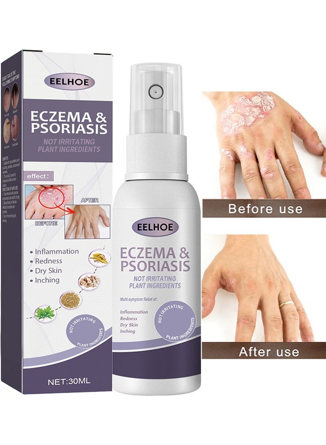 EELHOE Eczema And Psoriasis Atomizing Spray 30ML, Hand And Foot Moss Skin Repair, Relieve Itching, Skin Care And Jiejia Spray, Antibacterialnot Irritating Safety - Image 1