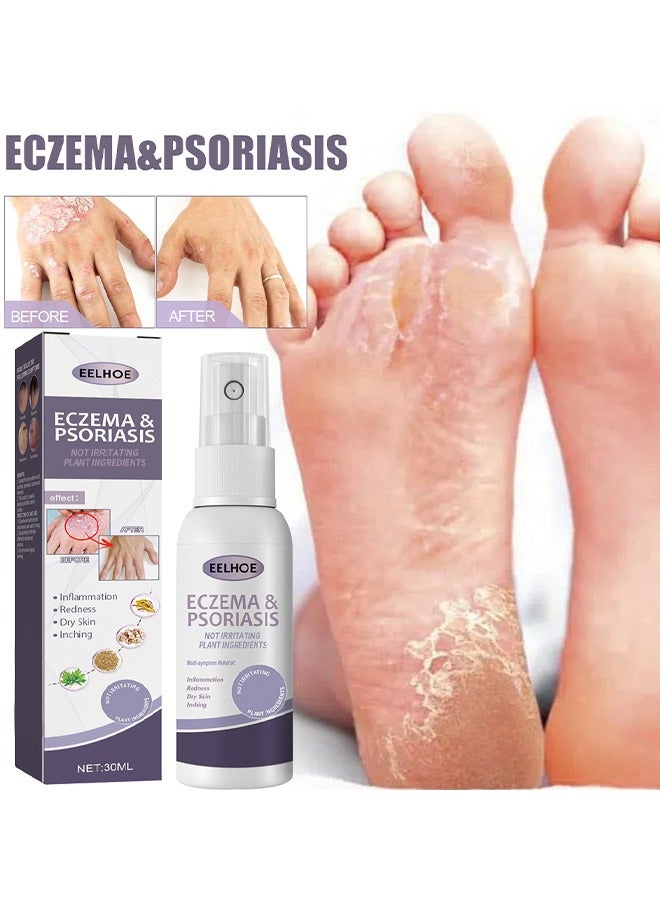 EELHOE Eczema And Psoriasis Atomizing Spray 30ML, Hand And Foot Moss Skin Repair, Relieve Itching, Skin Care And Jiejia Spray, Antibacterialnot Irritating Safety - Image 2